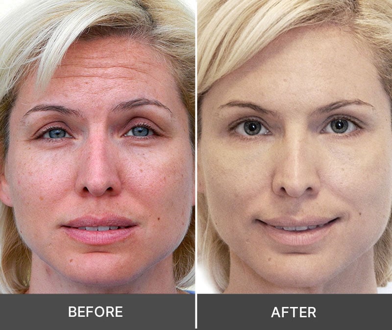 Idrotherapy Before Vs After
